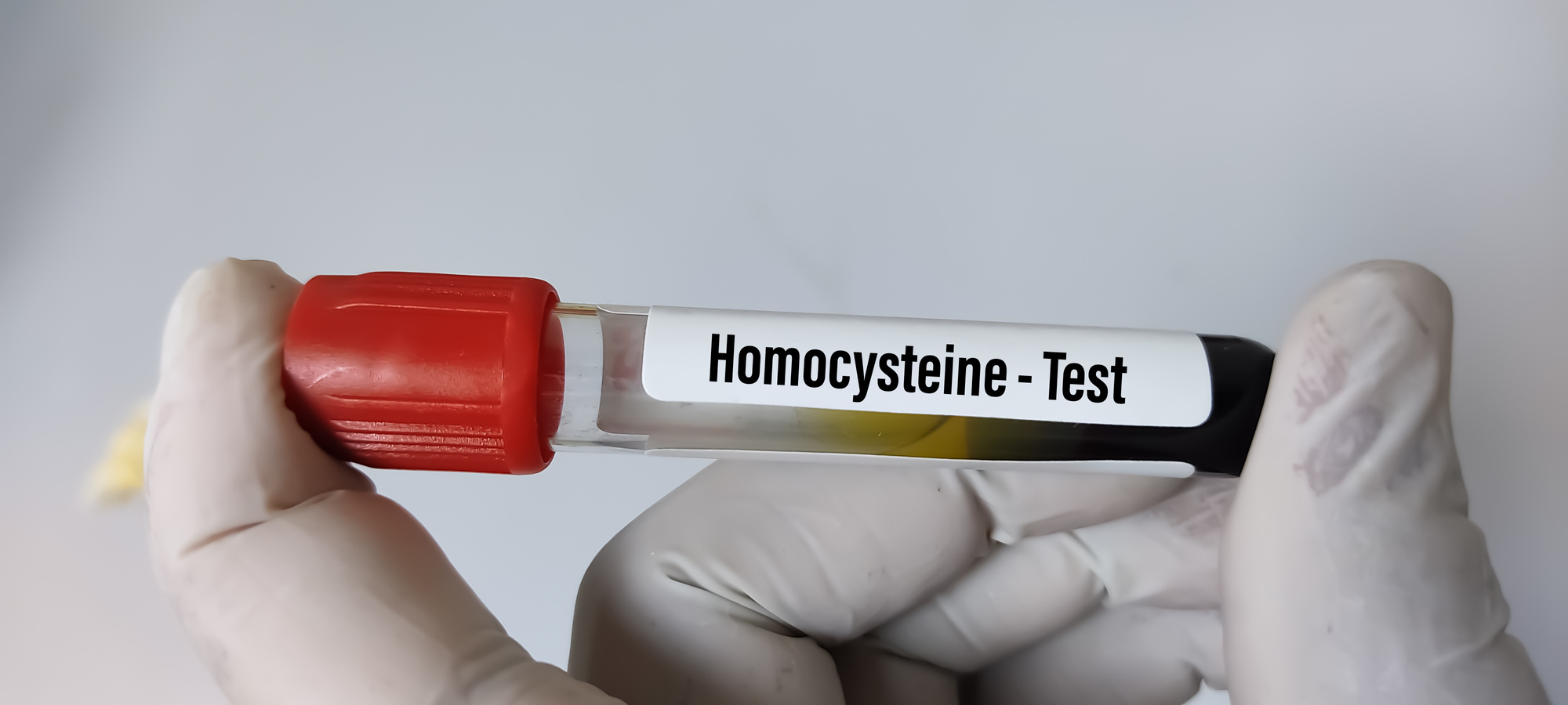 Blood sample tube for Homocysteine test